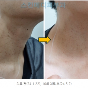 강남 청담 군집성흑자증(편측성흑자증) 저출력레이저 20회 치료 과정 1편 (난치성반점피부과)