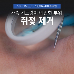 가슴 겨드랑이 쥐젖 제거_민감한 부위도 편안하게 청담 여의사피부과