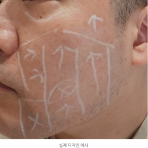 강남 청담 울쎄라 효과 결정하는 요인_피부과마다 효과 차이나는 이유