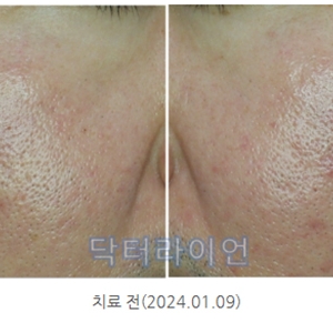 강남청담 모공+홍조 같이 치료해야하는 이유! 치료법 및 사례(쥬베룩/포텐자/브이빔퍼펙타)