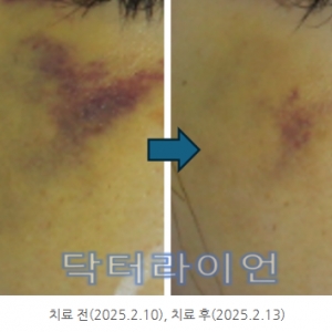 멍레이저 멍제거 복합치료 1회 전/후 사례5가지(쌍꺼풀수술멍, 코수술멍, 필러멍, 인모드멍)