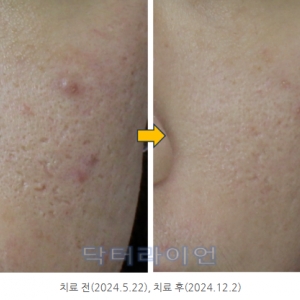 여드름흉터 '비박피성레이저+쥬베룩' vs '박피성레이저+도트필' _나의 흉터치료 철학