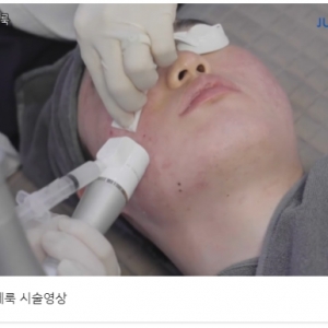 여드름흉터 미라젯+쥬베룩/쥬베룩볼륨 효과보는법 (시술영상)