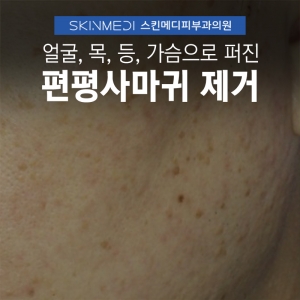 얼굴,목, 등, 가슴, 배로 퍼진 편평사마귀 제거(CO2레이저+면역력 증강요법)
