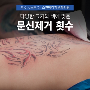 강남 청담피부과 타투 문신제거_예상 치료 횟수 확인하는 법