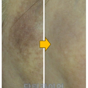 릴흑색증(릴흑피증) 헤나염색부작용 색소침착_새로운 레이저치료법 사례