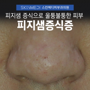 피지샘증식증 원인과 뿌리까지 제거가능한 레이저 치료법_스킨메디피부과