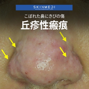 鼻のニキビ跡の凹凸の治療：丘疹性瘢痕