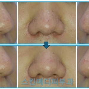 강남 청담 코 울퉁불퉁 비후성반흔 재발률 분석해봤습니다_CO2핀홀,아그네스,트리암주사(3004명치료)