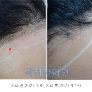 강남 청담 이마거상수술흉터 제거 레이저 치료 사례 및 방법(피부과전문의 닥터라이언)