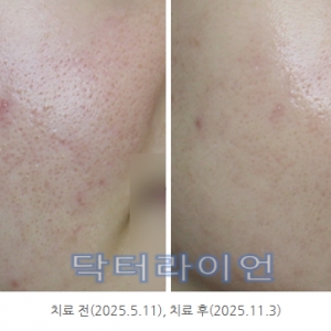 모공 치료, 정말 좋아질수있을까? 2만건 임상기반 ‘복합레이저 치료' 완전정리(미라젯·쥬베룩·포텐자)