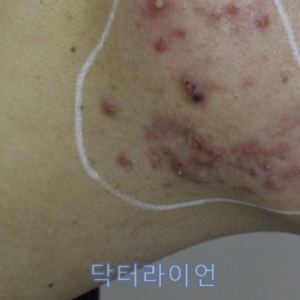 턱밑·턱선 울퉁불퉁한 흉터는? 켈로이드흉터 vs 비후성반흔 구별법과 레이저 치료방법 총정리