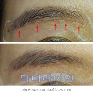 눈썹거상흉터 부작용 패인흉터 제거 레이저치료 방법 은? *전후사례*(흉터 피부과전문의)