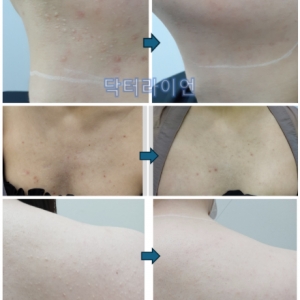 코비후성반흔(구진성흉터) 치료 5000례 분석으로 정리한 궁금증 총정리 - CO2핀홀,재발률,예방법