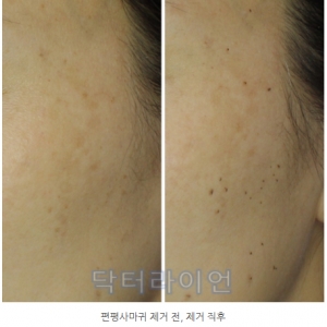 강남 청담 편평사마귀 듀오덤 안붙이는 레이저 치료법 VS 붙이는 치료법_비교분석(편사 10만명 후기)