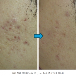 울트라펄스알파, 여드름흉터 치료의 끝판왕 등장!_vs 울트라펄스앙코르 효과비교분석