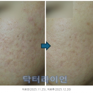 쥬브아셀/리투오 여드름흉터·모공 치료 효과 200케이스 분석_미라젯/포텐자/손주사/하이쿡스(3편)