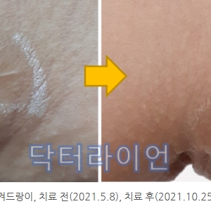 지방흡입흉터 제거 레이저_7가지 종류별 치료법 전후 사진(팔뚝/허벅지/겨드랑이/복부/이중턱)