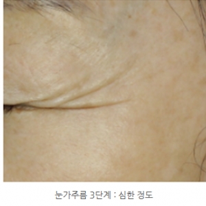 아이써마지 225샷 vs 450샷 | 눈밑주름·눈가리프팅 효과비교와 선택법 & 가격차이