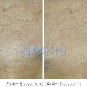 TCA 도트필 부작용, 추천하지 않는 이유_더 효과적인 레이저는?