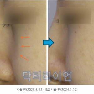 강남청담 쥬베룩볼륨 앞볼, 앞광대 효과_테크닉 및 노하우 공개(시술 전후 사진)