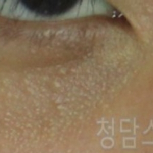 눈밑 한관종 제거 방법이 다양한 이유는? *아그네스 의 한계점*(피부과전문의 견해)