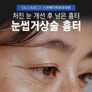 강남 청담 눈썹하거상 흉터 수술 자국 레이저 치료 후기