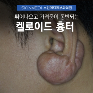 강남구청 청담 켈로이드 흉터 주사, 레이저 치료 방식의 차이는?