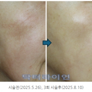레디어스 인디언주름·입가주름·인중주름·볼패임ㅣ시술사례와 효과 총정리(테크닉의 중요성)