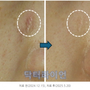 대상포진 흉터 치료 사례 |10회 복합레이저로 말끔히 개선된 실제 전후 & 치료방법 총정리