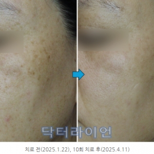 레이저토닝으로 치료안되는 기미 제거 새로운 방법 사례 크롬레이저+미라젯레이저