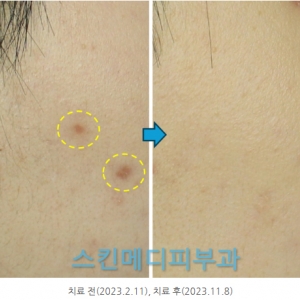강남 청담 써마지 올리지오 울쎄라 튠페이스 부작용 화상흉터 사례_원인 및 치료 해결법