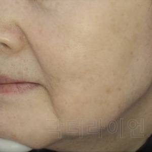 써마지 볼처짐 효과 있을까? 볼처짐 유형별 써마지 vs 울쎄라 선택 기준 정리(시리즈 3편)