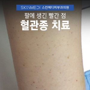 얼굴 팔 빨간점, 체리혈관종 레이저 치료_강남구청피부과