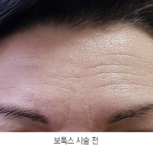 보톡스내성 원인, 해결 예방법_제오민/코어톡스 사용하는 이유(국산 VS 수입)