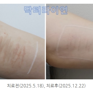 자해흉터 주저흔 치료 새로운 방법_울트라펄스알파 레이저 사용 후기(피부과전문의)