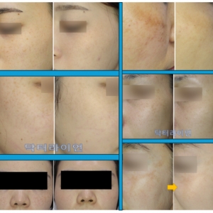 레이저토닝 vs 피코토닝 vs 제네시스토닝, 전부 토닝인데 왜 효과가 다를까?(기미 치료 타겟의 차이)