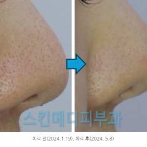 강남 청담 코모공 쥬베룩/쥬베룩볼륨 효과는? 어떻게 치료해야 좋을까?(2만명 치료 피부과전문의)