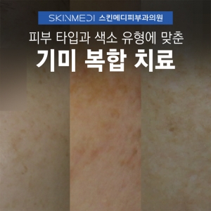 기미 제거 레이저 시술_피부 타입과 유형에 맞춘 복합 치료법