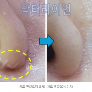 강남 청담 콧볼축소흉터 수술흉터제거 레이저 사례 전후 사진(수백케이스 치료후기)
