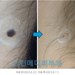 선천성모반/튀어나온점 수술없이  레이저로 제거하는 방법  (다양한 치료사례)