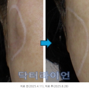 얼굴 함몰·패인흉터 유착흉터 치료후기| 서브시전+피코프락셀+미라젯 복합치료효과(165번째사례)