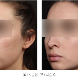 엑시온 리프팅 완전분석_울쎄라·써마지 효과를 동시에? 원리·효과·적응증 총정리