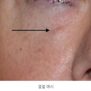 리투오·쥬브아셀, 결절 부작용 정말 안생길까?_쥬베룩볼륨과 차이점(4편)