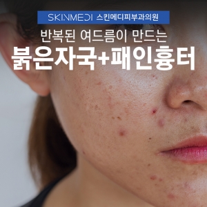 청담피부과 여드름 붉은자국 패인흉터 동시 치료의 장점