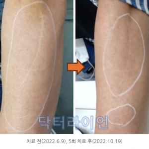 강남 청담 팔흉터 수술흉터 봉합흉터 다친흉터제거 레이저 치료 노하우 공개!(시술방법 및 전후사진)