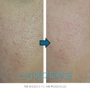 강남 청담 울쎄라 나비존 모공 개선효과 있을까? 치료 노하우 및 사례(피부과전문의 닥터라이언)