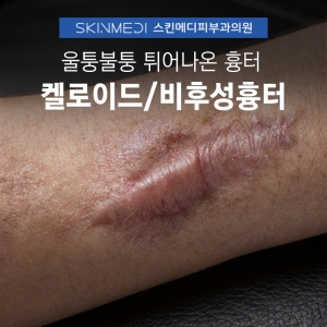 강남 청담 튀어나온 흉터 켈로이드/비후성흉터 치료(주사, 레이저, 냉동치료)