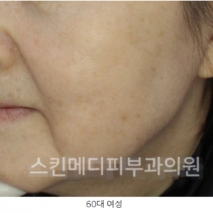 울쎄라 써마지 FLX 300샷? 600샷? 900샷? 나에게 필요한 샷수 아는방법